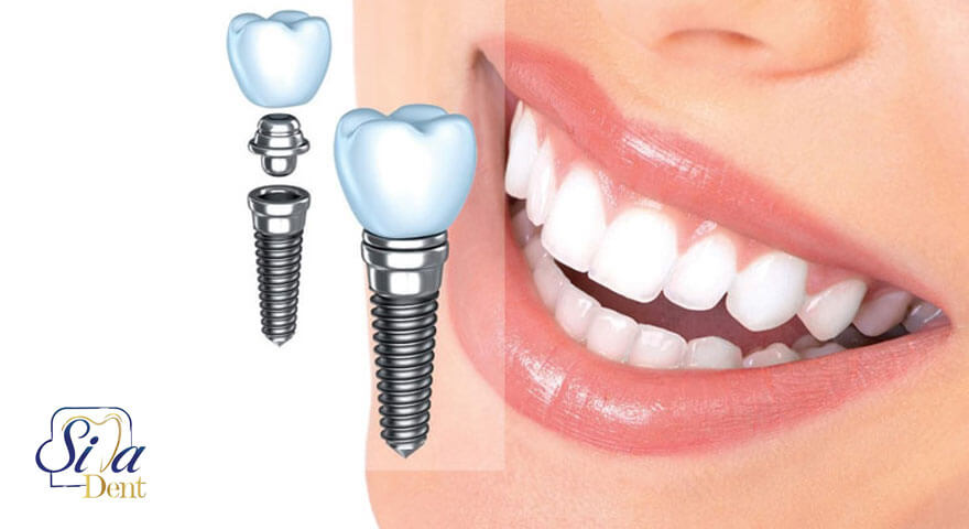 مراقبت های لازم جهت نگهداری ایمپلنت دندان