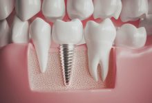 ایمپلنت دندان جایگزین مناسب برای دندان