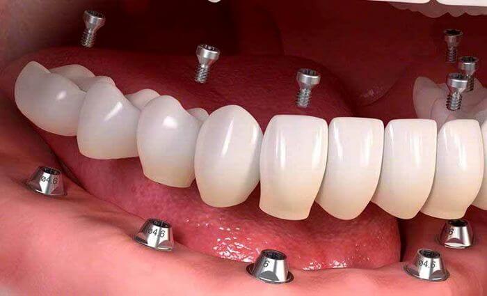 معایب و مزایای ایمپلنت دندان