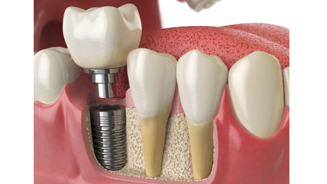 ایمپلنت دندان جایگزین مناسب برای دندان